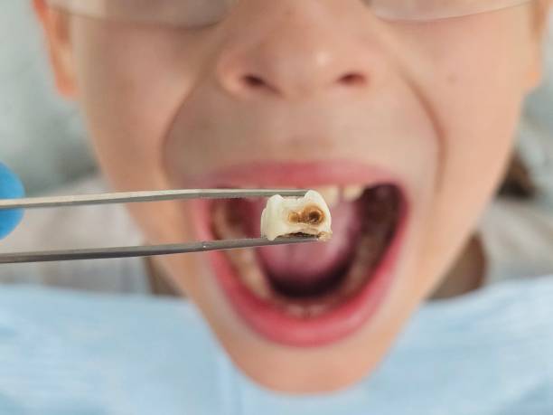 Best Emergency Dental Care for Broken or Chipped Teeth in Kankakee, IL