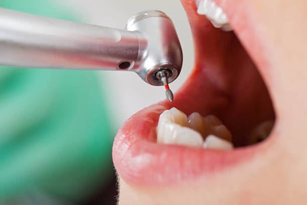Best Emergency Treatment for Dental Infections or Abscesses in Kankakee, IL